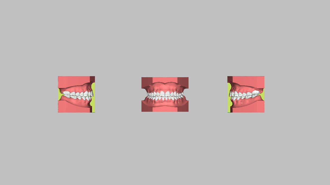 3D DENTOLIGN ALIGNER TREATMENT PLANNING