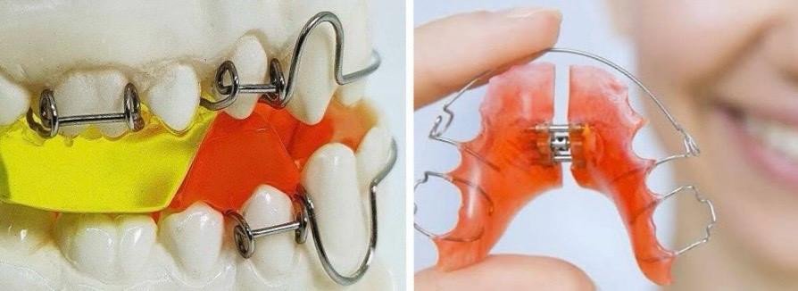 Orthodontic Appliances Dentolab